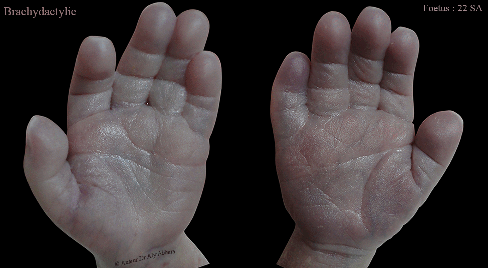 Brachydactylie, clinodactylie, Pli palmaire transverse unique - قِصر الأصابع - اِنحناء الأصابع - ثلم راحي عرضي وحيد - تثلث الصبغي 21