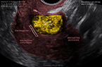 Utérus :  myome intra-mural antérieur calcifié chez une patiente âgée de 57 ans