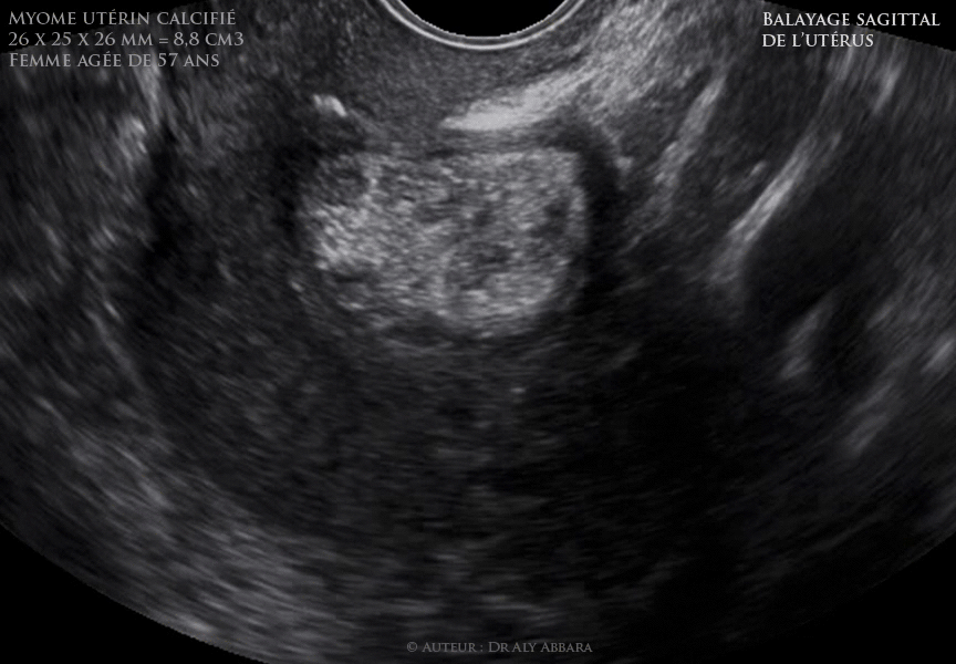 Utérus :  myome intra-mural antérieur calcifié ou tumeur lipomateuse utérine chez une patiente âgée de 57 ans