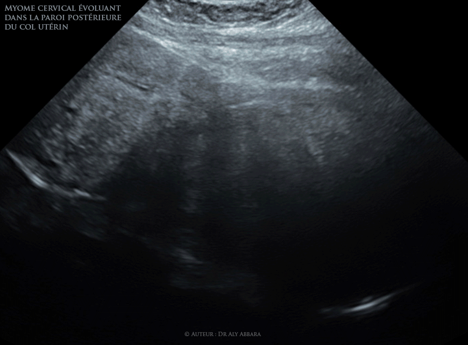 Fibrome cervical à développement endovaginal