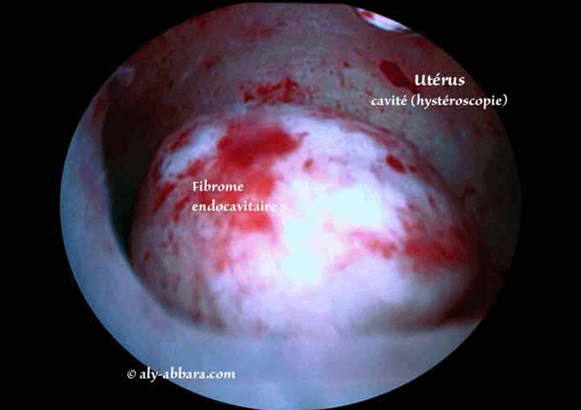 Myome sous muqueux pédiculé (classe 0 de FIGO)