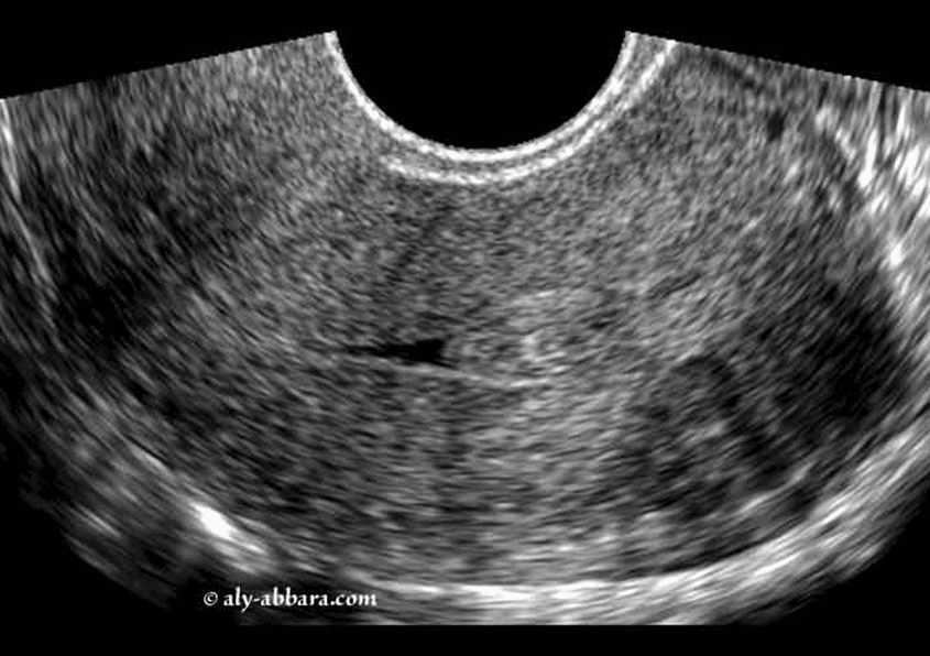 Myome sous muqueux classe 0 de FIGO