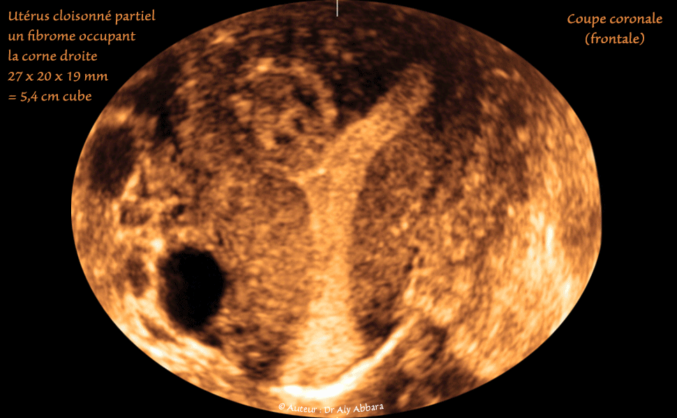 Utérus malformé, cloisonné partiellement, avec myome sous muqueux de classe 0 évoluant dans le compartiment droit de la cavité utérine