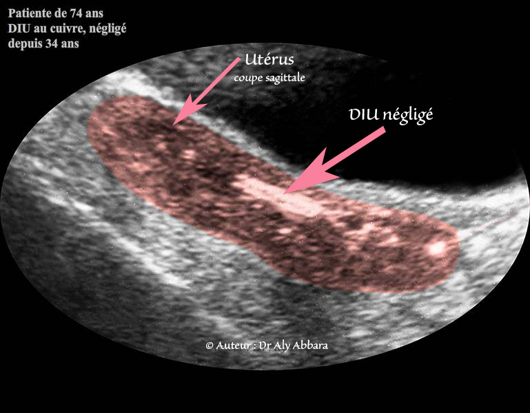 Stérilet négligé dans l'utérus durant 34 ans