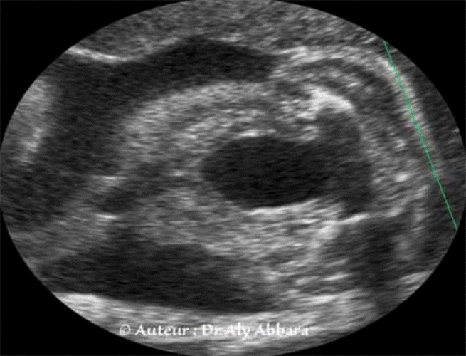 Artère ombilicale unique