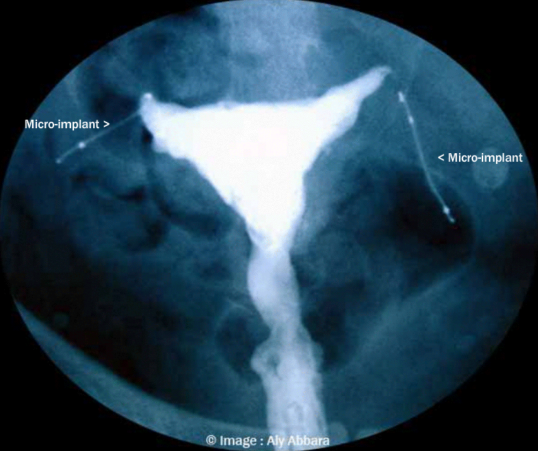 Hystérosalpingographie 3 mois après la pose correct des dispositifs intra-tubaire cotraceptifs définitis