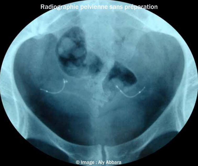 Dispositifs intratubaires contraceptifs définitifs -Aspect radiologique sans préparation