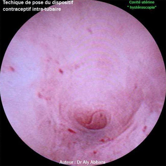 Dispositif intra-tubaire contraceptif définitif - Stérilisation tubaire définitive