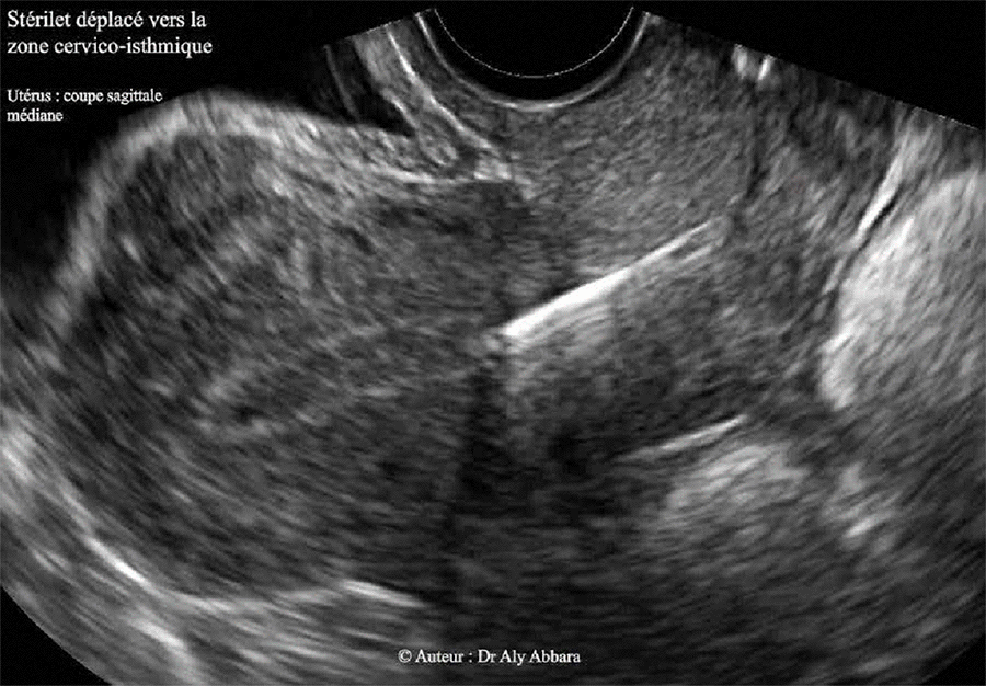Dispositif intra-utérin (DIU) - déplacement vers la région isthmique de l'utérus