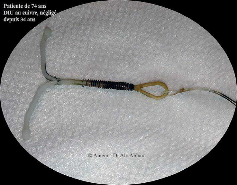 Dispositif intra-utérin négligé dans l'utérus durant 34 ans