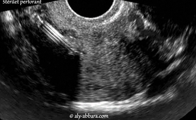 Dispositif intra-utérin hormonal perforant la parois latérale droite de l'utérus