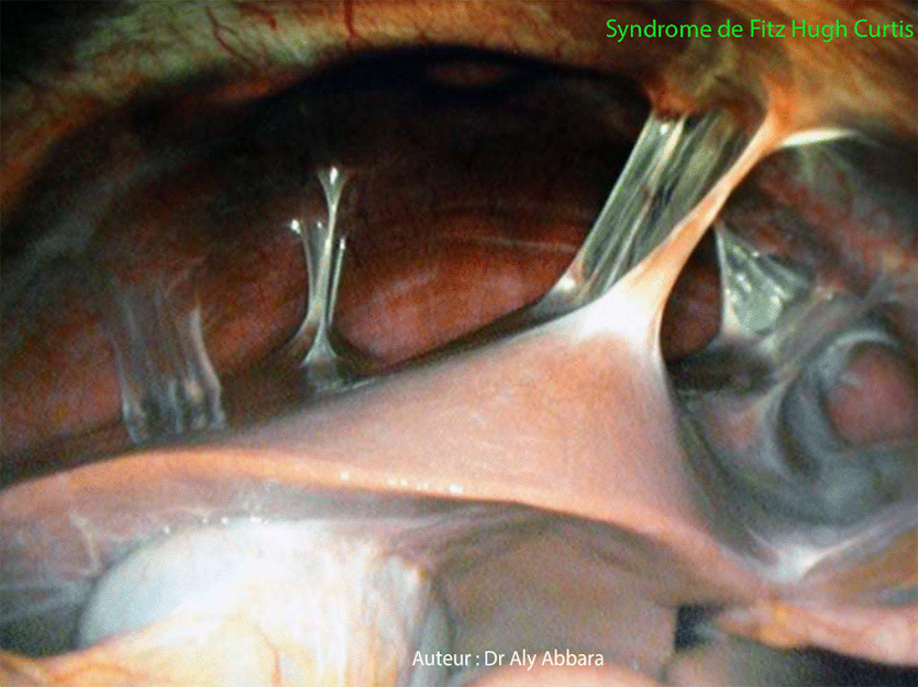 Périhépatite - Images cliniques  coelioscopiques