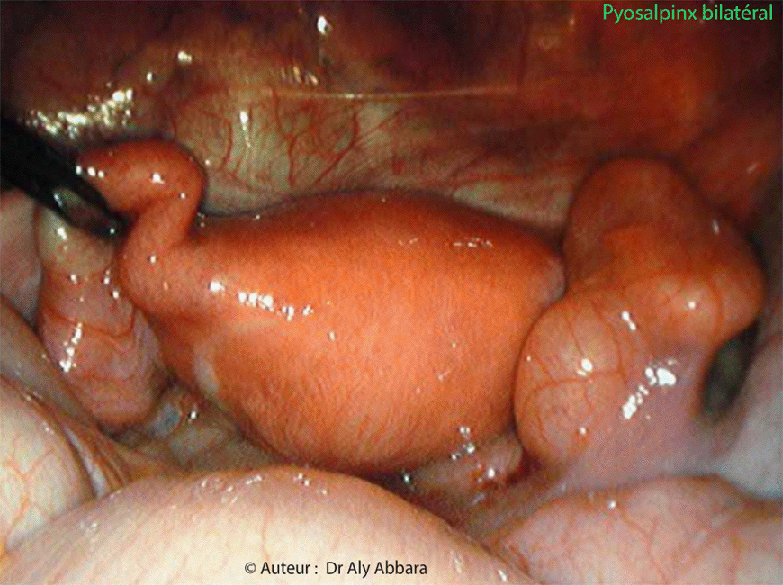 Infection génital haute - Pyosalpinx bilatéral - Images cliniques coelioscopiques