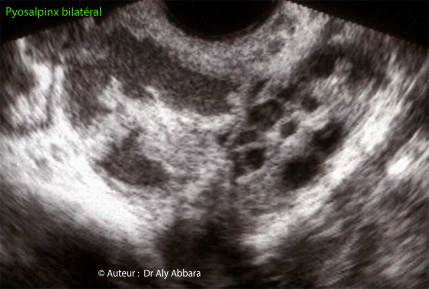 Infection génital haute - Pyosalpinx bilatéral - Echographie