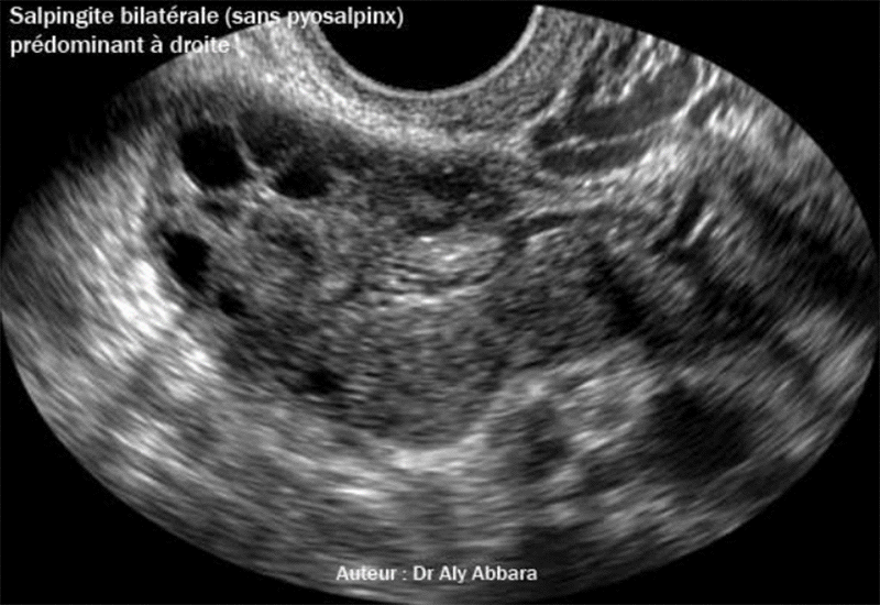 Infection génitale haute - Salpingite aigue bilatérale - Images échographiques