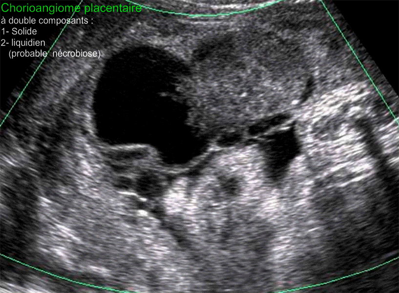 Chorioangiome placentaire, mixte comportant deux composantes, solide et kystique (probablement enkystation par nécrobiose) - Hydramnios sévère