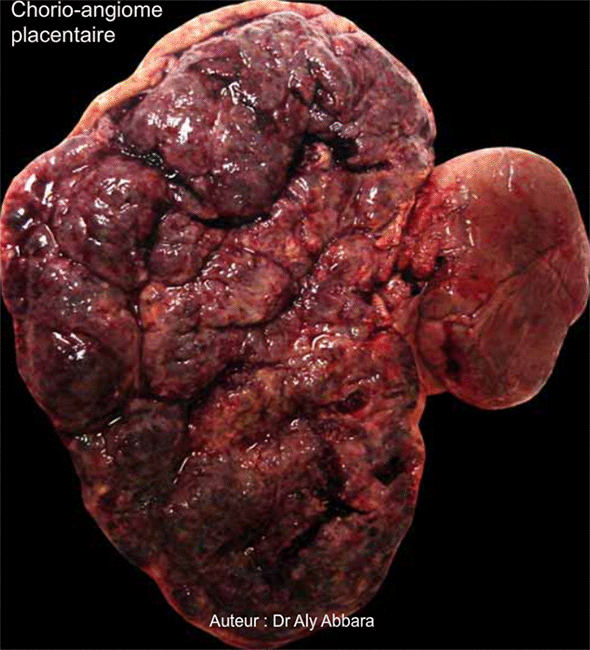 Chorioangiome placentaire - Image clinique du placenta
