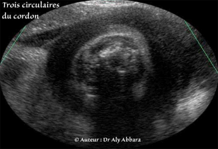 Cordon ombilical - Triple circulaires - 39 SA - Echographie
