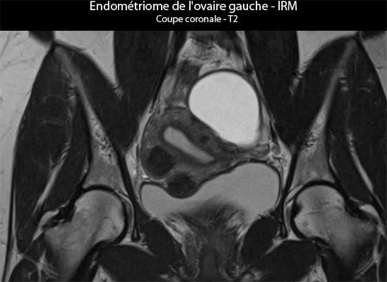 Endométriome de l'ovaire gauche - IRM