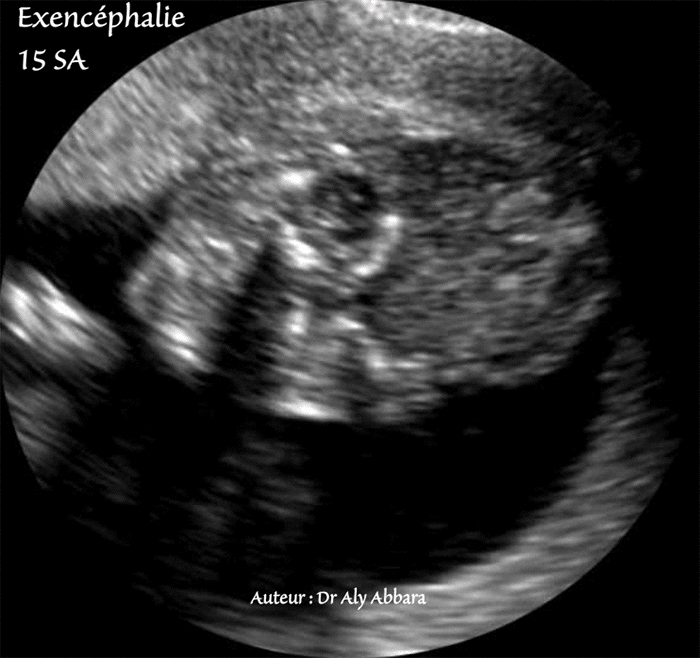 Exencéphalie - 15 SA - Coupe échographique frontale (coronale)