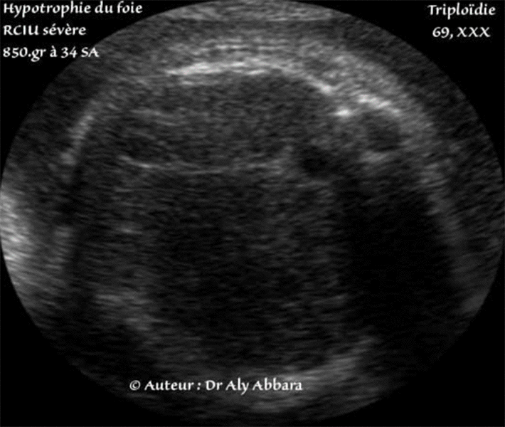 Hypotrophie du foie - Foetus ateint d'une triploïdie (69 chromosomes) - 34 SA