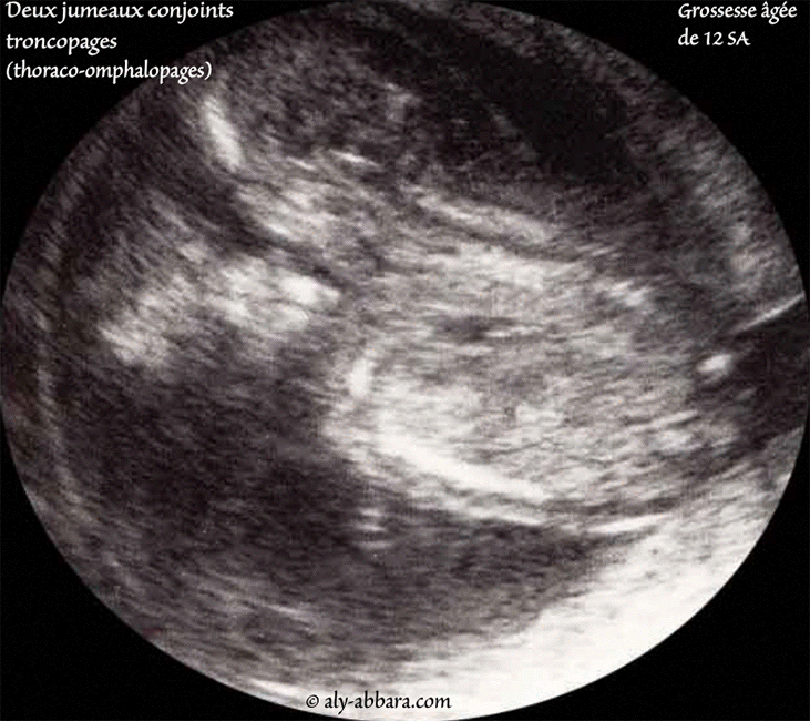 Grossesse gémellaire - Jumeaux conjoints troncopages - 12 SA