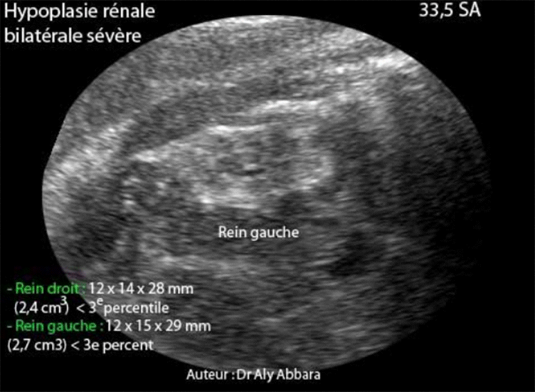 Hypoplasie rénale bilatérale à 33,5 SA - coupe échographique rénale antéro-postérieure