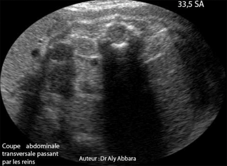 Hypoplasie rénale bilatérale sévère à 33,5 SA avec anamnios