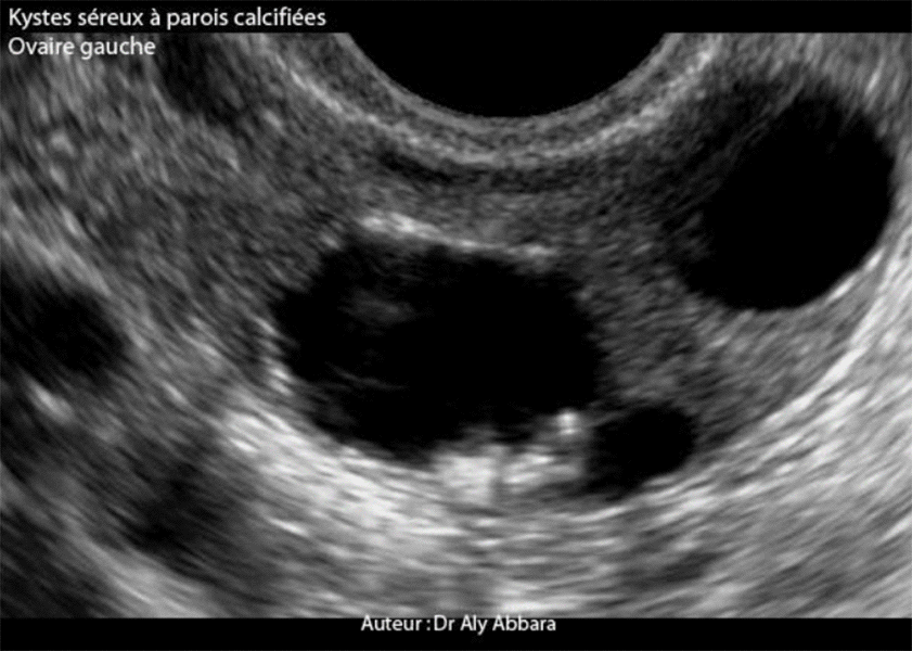 Ovaire gauche porteur de deux petits kystes séreux