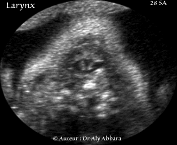 Lrynx foetal à 28 SA -Anatomie échographique