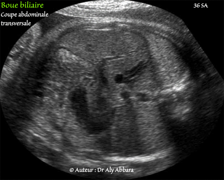 Boue biliaire - Foetus de 38 SA