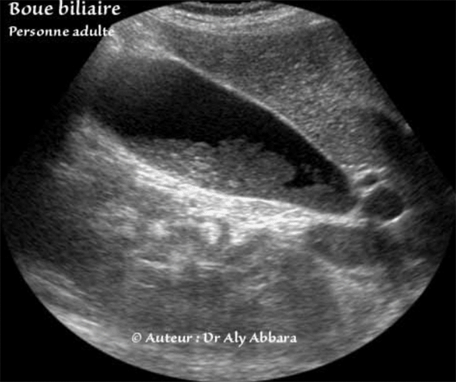 Boue biliaire chez une femme agée de 33 ans