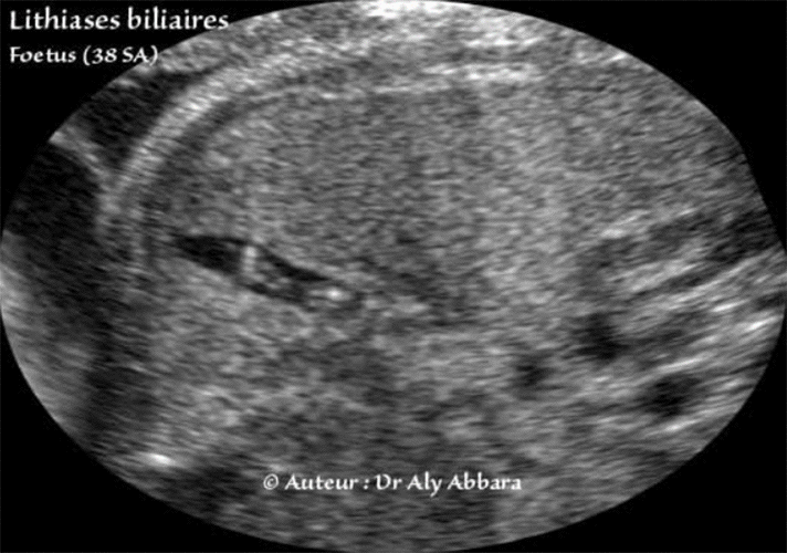 Lithiases biliaires - Foetus à 38 SA