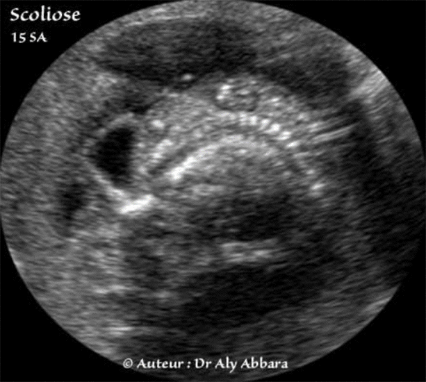 Scoliose (courbure latérale constante de la colonne vertébrale - Foetus âgé de 15 SA