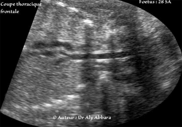 Trachée - Anatomie échographique