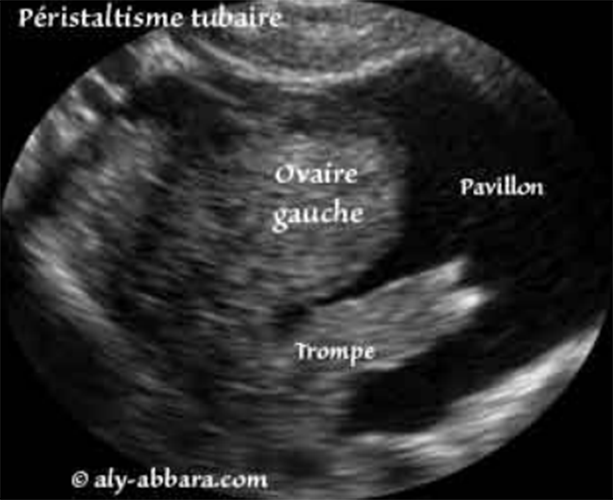 Péristaltisme tubaire - Images échographiques