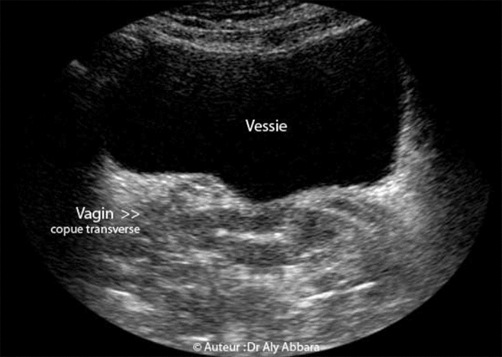 Vagin de femme adulte - Coupe transverse - Echographie et IRM