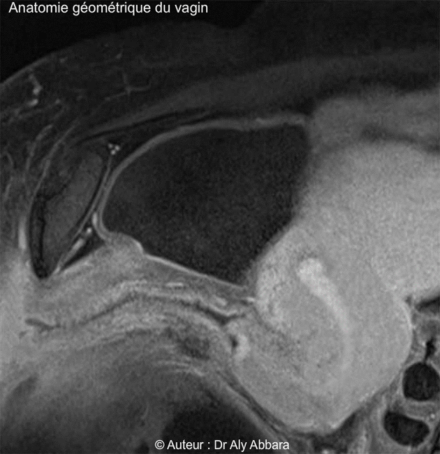 Petit pelvis - rapports anatomiques - Vagin - IRM