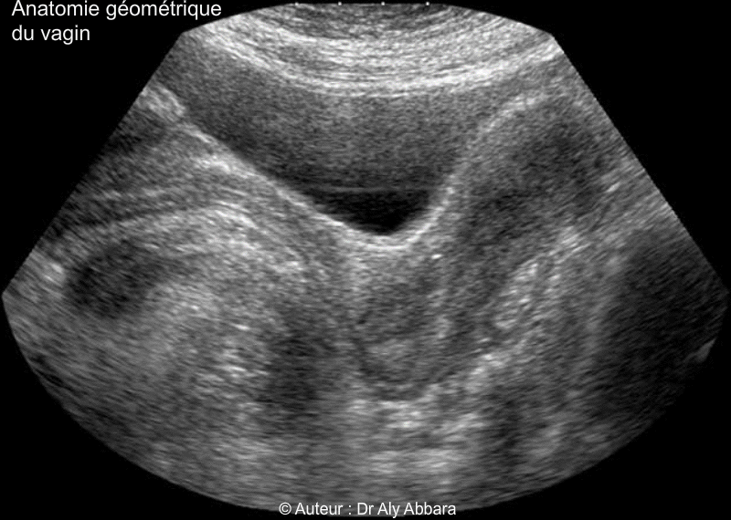 Vagin de femme adulte - Rapports anatomiques - Echographie