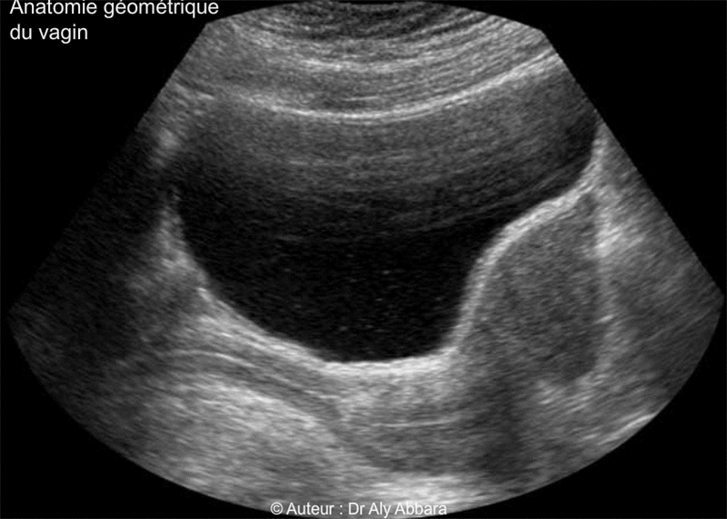 Vagin de femme adulte - Rapports anatomiques - Echographie