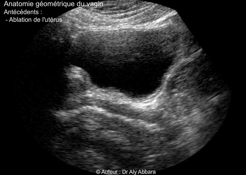 Vagin de femme adulte ayant déjà eu une hystérectomie totale - Rapports anatomiques - Echographie