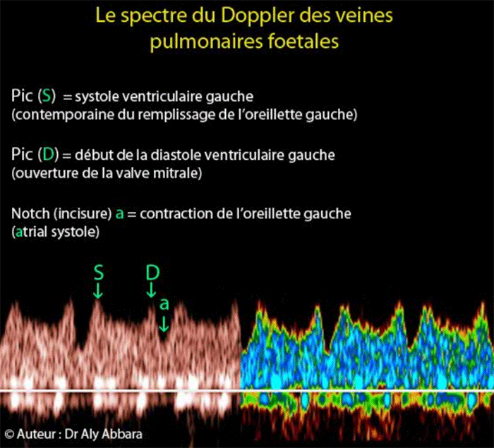 Veine pulmonaire 'retour veineux) - Spectre Doppler