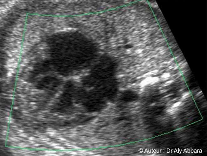 Le retour veineux cardiaque (vers l'oreillette gauche) - Les quatre veines pulmonaires