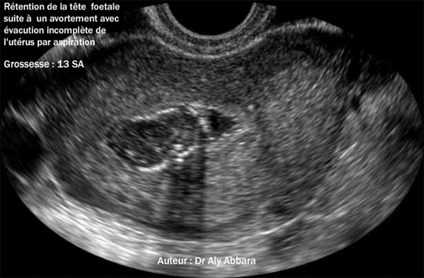 Rétention du pôle céphalique d'un foetus de 13 SA suite à une FCS incomplet