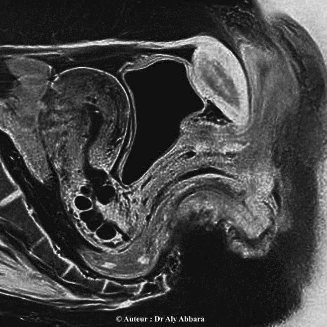 Anatomie du pelvis - coupe sagittale médiane - utérus, adénomyose, kystes de Naboth, vagin, vessie et rectum