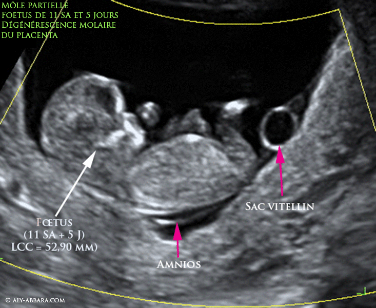 Grossesse molaire partielle - Foetus vivant de 11 SA et 5 jours, morphologiquement normale, présence d'une cavité amniotique et d'un sac vitellin, mais placenta en état d'une dégénréscence molaire polyvésiculaire
