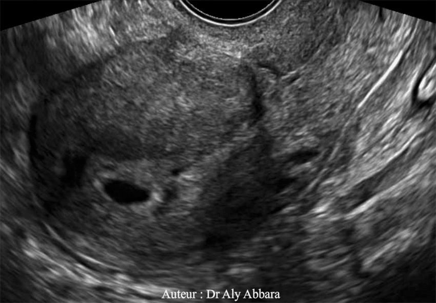Utérus cicatriciel et gravide - Grossesse de 5 SA