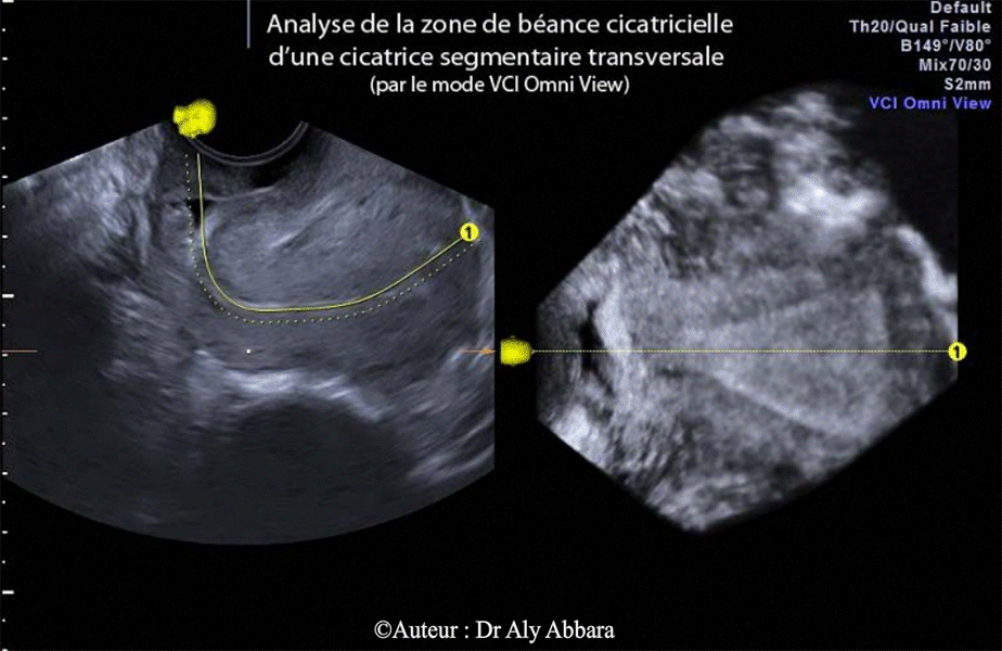 Utérus cicatriciel - Isthmocele - Echographie mode Omni