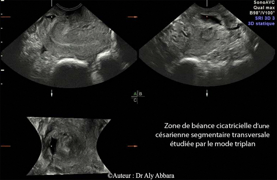 Utérus cicatriciel - Isthmocèle - Echographie mode Triplan