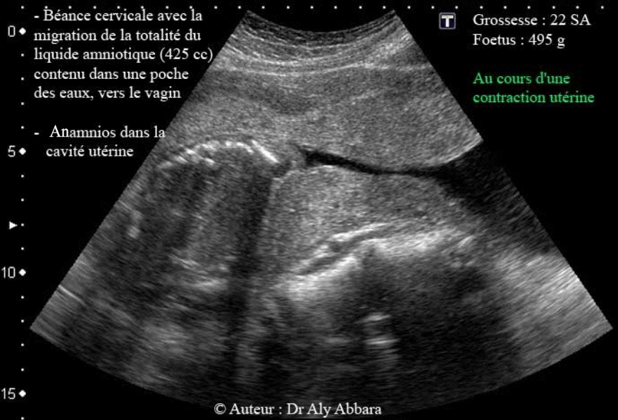 Béance du col utérin à 22 SA - Poche des eaux dans le vagin